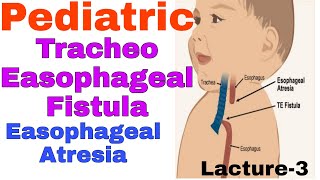 Tracheoesophageal fistula in hindiEsophageal Atresia  TEF EA  staff nurse online classes [upl. by Auehsoj]