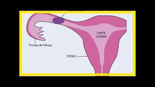 Qu’estce qu’une grossesse extrautérine   26032018 [upl. by Ative]