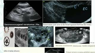 Mangement of ovarian cyst by Dr Ghada Essa [upl. by Merv]