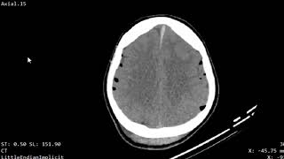 CASE 960 CT BRAIN hemorrhagic contusion pneumocephalus skull base fracture [upl. by Myrah747]