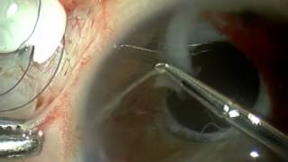 Neovascular Glaucoma Treatment With Extraction of Anterior Chamber Fibrovascular Tissue [upl. by Aivil513]