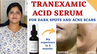 How I Cleared My Acne Scars in 30 Days [upl. by Nayarb]