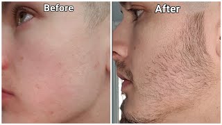 Minoxidil Beard  5 Month Beard Transformation  2022 Update With Pictures [upl. by Essex]