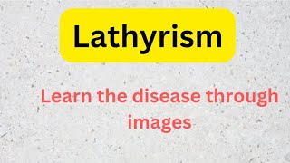 Lathyrism  Learn through images for doctorsnurseshealth professionals [upl. by Otrebogir248]