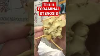 What FORAMINAL STENOSIS Really Looks Like Must See  Dr Walter Salubro [upl. by Edva]