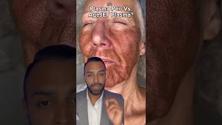 Plasma Fibroblast Vs AgeJet Plasma Which One Dr Somji Explains [upl. by Drofnil397]