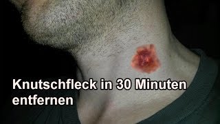 Knutschflecken mit Mundwasser in 30 Min entfernen  Knutschfleck schnell wegbekommen  Tutorial [upl. by Jacquenette]