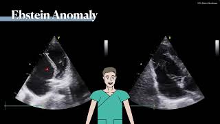 〖Echocardiography〗 Ebstein anomaly 💘 [upl. by Nalahs508]