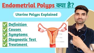 Endometrial Polyp in Hindi  Causes Symptoms And Treatment of Endometrial Polyp [upl. by Almire]