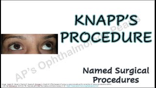 Knapp’s procedure  Named Surgical Procedures [upl. by Viola725]