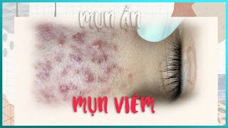 Big Cystic Acne Blackheads Extraction Blackheads amp Milia Whiteheads Removal Pimple Popping [upl. by Wunder]