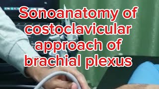 Sonoanatomy of costoclavicular approach of the brachial plexus [upl. by Baptiste]