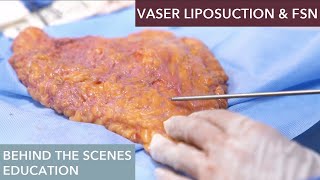 How does Vaser Liposuction work [upl. by Gnouhc895]