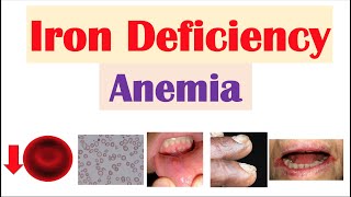 Iron deficiency anemia symptoms and treatment [upl. by Scheers503]