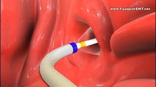 Balloon Eustachian Tube Dilation to Treat Eustachian Tube Dysfunction [upl. by Asirem]