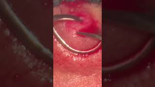 Chalazion surgery Chalazion Expert Advice for Quick Healing [upl. by Cann]