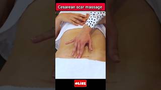 Cesarean delivery ke baad swelling pain tight Ness kam kare shorts Cesareanmassage [upl. by Ikkir]