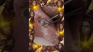 Blackheads Removal  Acne Treatment and Very Satisfying Satisfying Pimple pop blackheads [upl. by Enyala]