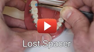 What to do about a lost spacer [upl. by Aicilf61]