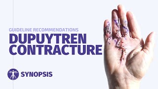 Dupuytrens Contracture Guideline  SYNOPSIS [upl. by Ahsot473]