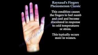 Raynauds Fingers Phenomenon classic  Everything You Need To Know  Dr Nabil Ebraheim [upl. by Assylem]