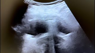 Ultrasound of Emphysematous cystitis in 65 yr diabetic female [upl. by Anifled]