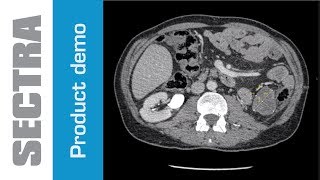 Sectra Lesion Tracking [upl. by Aitret]