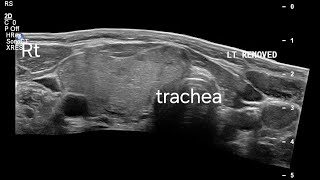 UltrasoundGuided FNAC in PostHemithyroidectomy with Multinodular Goiter Imaging Findings [upl. by Siari]