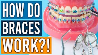 How Do Braces Work [upl. by Castle83]