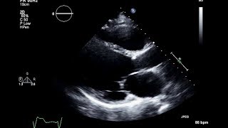 Ischemic Cardiomyopathy 2D Echocardiogram [upl. by Asilrac]