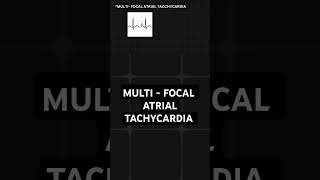 multifocal atrial tachycardia  ECG basics [upl. by Jun671]