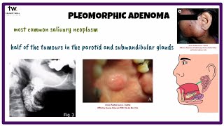 Pleomorphic Adenoma  Histopathology [upl. by Beatrisa769]