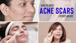 Treatments for ACNE SCARS  Dr Bindus Expert Advice [upl. by Soalokin]