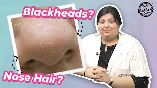 Nose Hair or Blackheads  How to Remove Nose Hair  Trichostasis Spinulosa [upl. by Nevai]