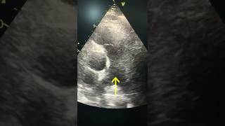 quot¿Qué revela la arteria pulmonar en una ecocardiografía 🌬️ Descúbrelo en 60 segundos Medicinaquot [upl. by Eserehc]