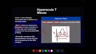 Hyperacute T Waves as a STEMI Equivalent [upl. by Serra]