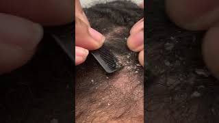 Itchy Dry Scalp  Dandruff Picking ASMR [upl. by Salba]