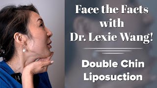 Lower Face amp Neck Submental Liposuction  Face the Facts with Dr Wang  West End Plastic Surgery [upl. by Ameekahs500]