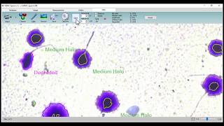 MMC Sperm DNA fragmentation analysis [upl. by Horlacher]