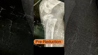 Close reduction of proximal epiphyseal slip of tibia in kids  SALTERHARRIS type 1 [upl. by Aikel]