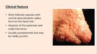 Lecture90 Acquired disorders of Epidermal keratinization PartII Rooks chapter 87 [upl. by Colson]