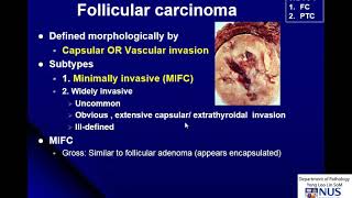 Thyroid Carcinoma Gross and Micro [upl. by Laurita735]