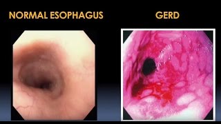 Diagnosis and Treatment for Esophageal and Motility Disorders Video  Brigham and Womens Hospital [upl. by Assyli647]