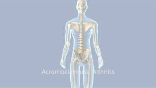 Acromioclavicular Arthritis [upl. by Lesser]