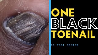 One Black Toenail Fungal Toenail Infection or Not [upl. by Ezaria]