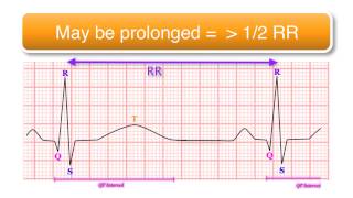 ECG basics 1010  The QT Interval [upl. by Nais702]