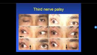 Diplopia 26  Types of Strabismus [upl. by Amby416]