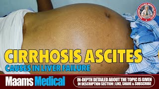 Ascites Fluid Buildup Causes Symptoms and Treatment  Maams [upl. by Abroms]