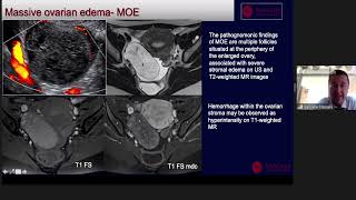 Oncological Imaging Practical Approach  quotMimics of Malignancy Andexal by Dr Gabriele Masselli [upl. by Shaylynn409]