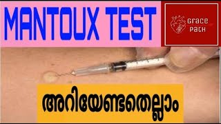 Mantoux Test  Tuberculin Skin Test TST Malayalam [upl. by Evelyn]